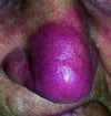 Sarcoïdose (Lupus pernio)