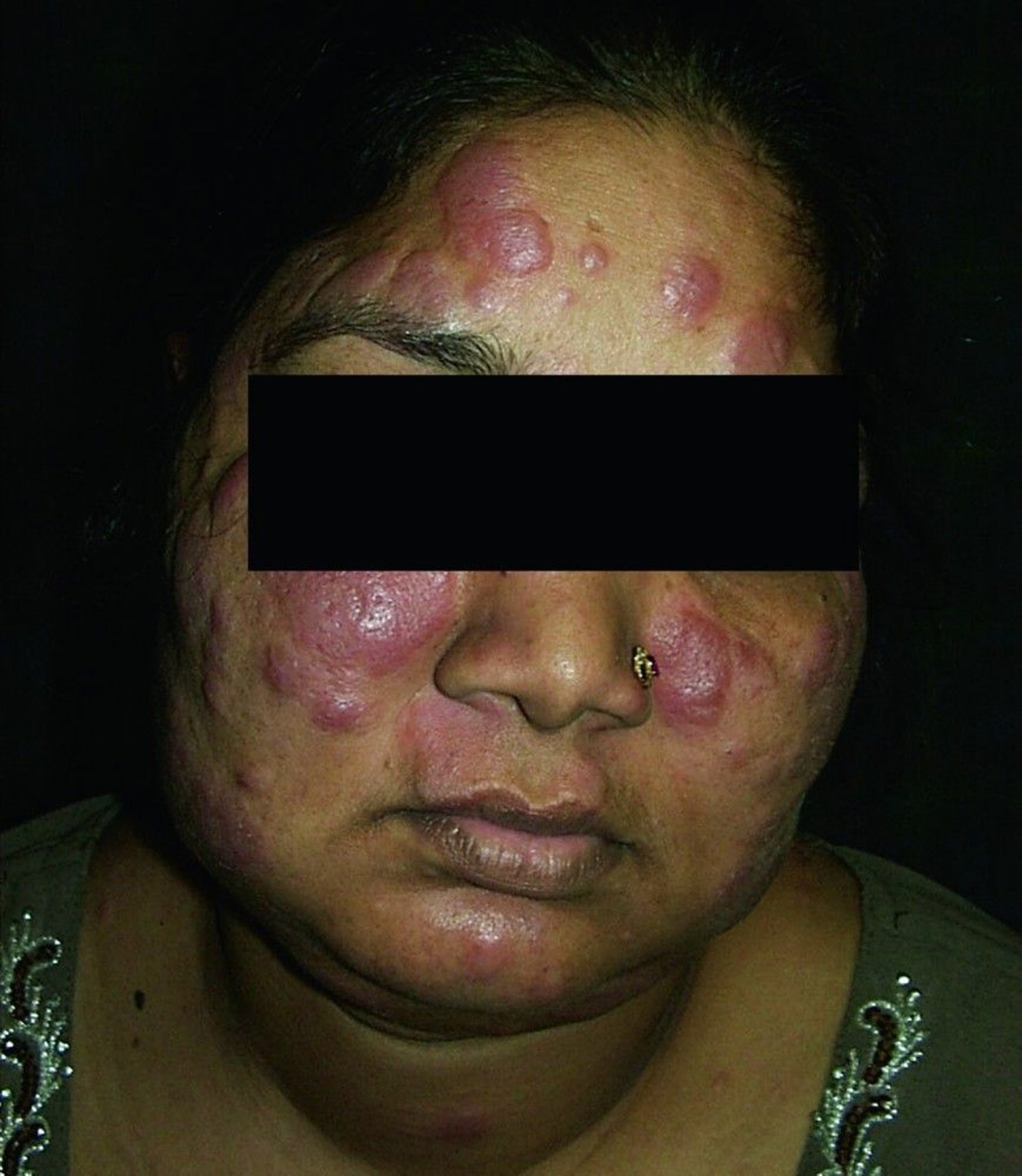 Skin Sarcoidosis (Plaques)