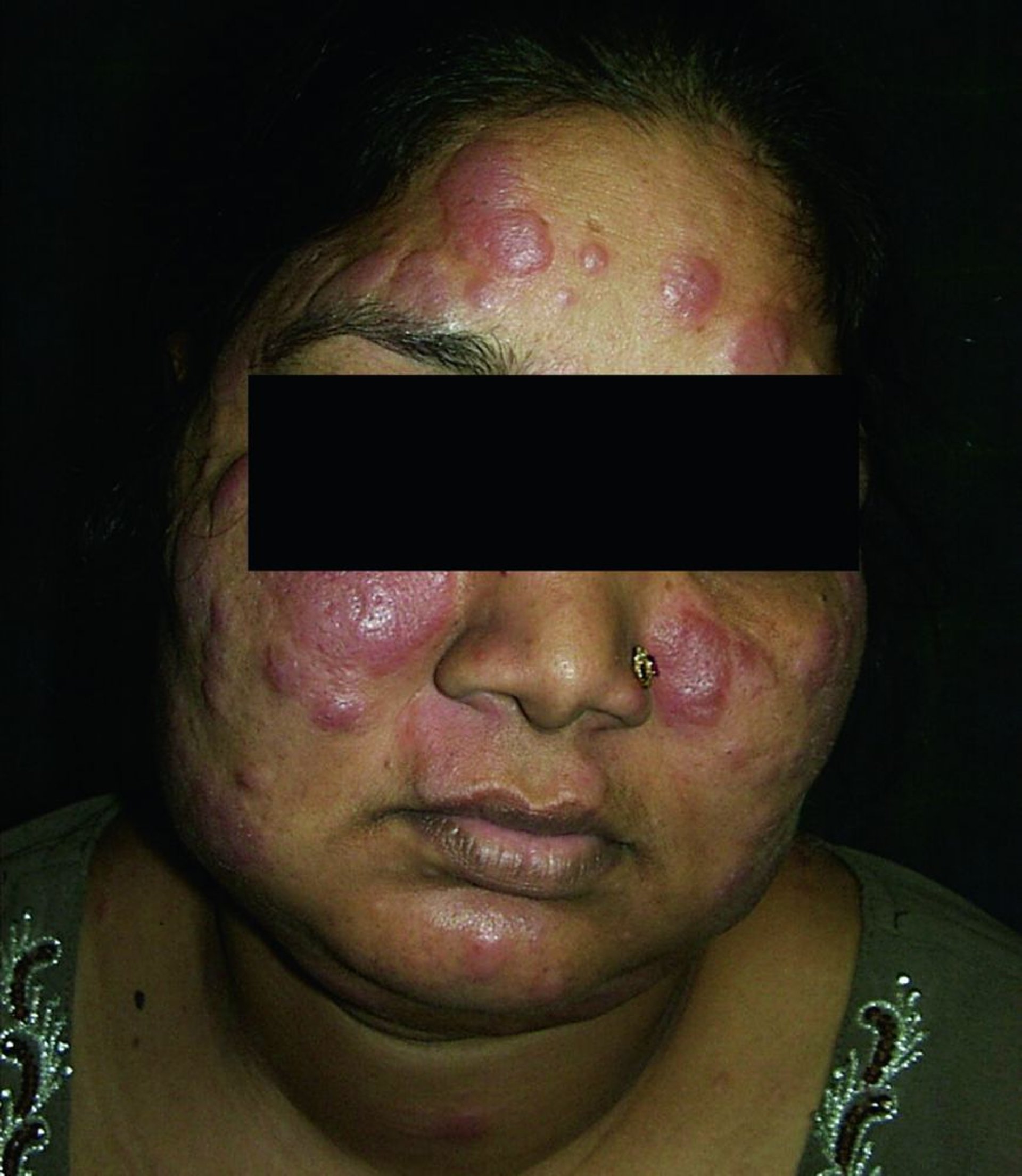 Sarcoidosis cutánea (placas)