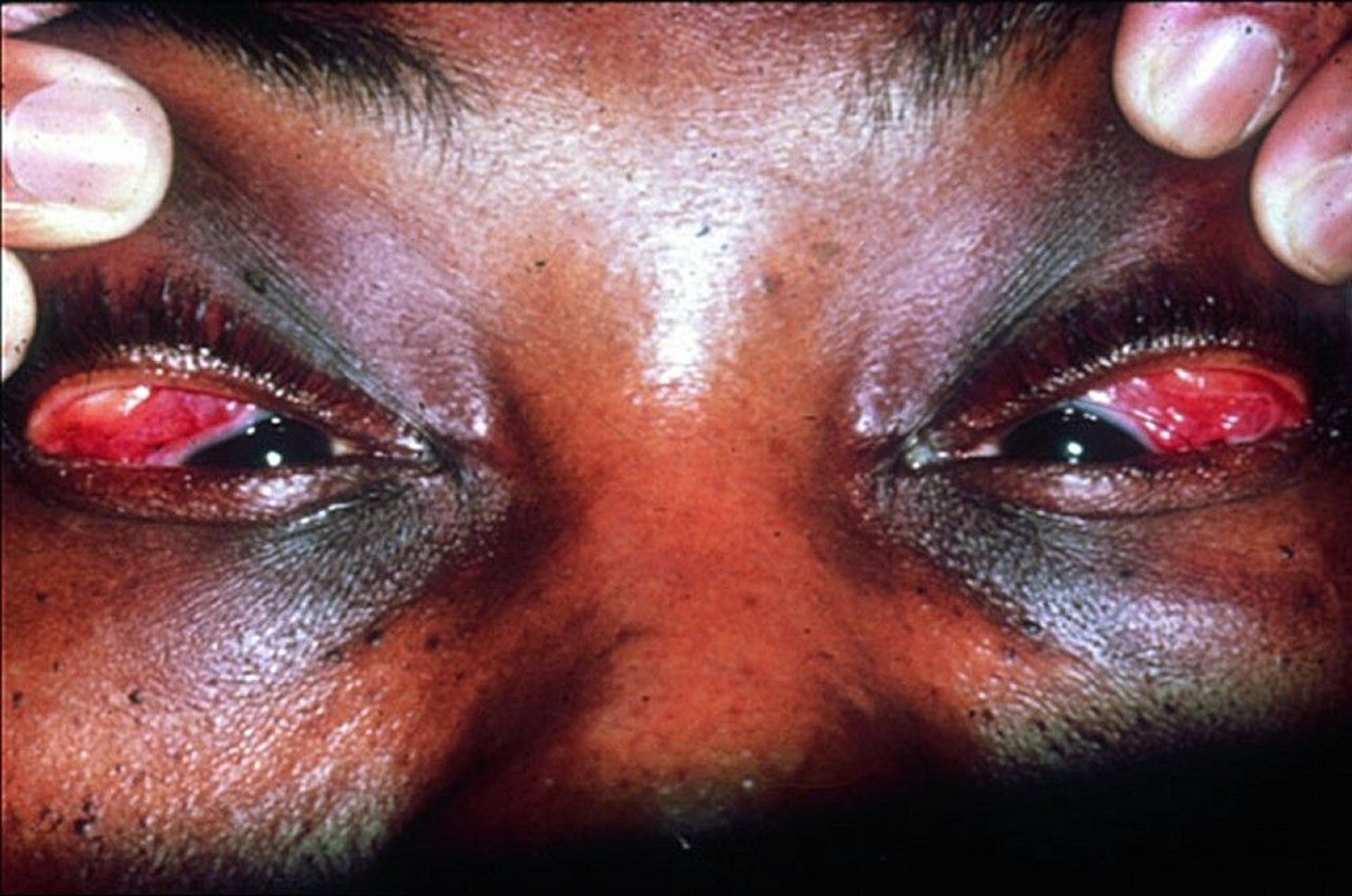 Sarcoidosis (Dacryocystitis)