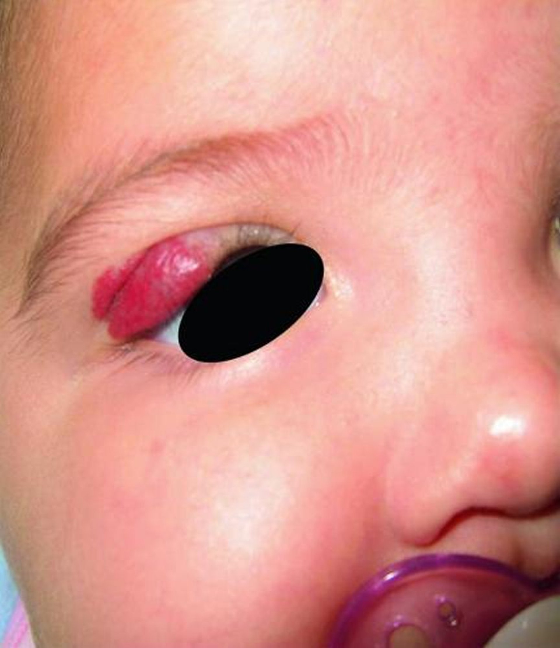 Hemangioma periocular infantil