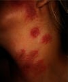Akute febrile neutrophile Dermatose (Sweet-Syndrom)
