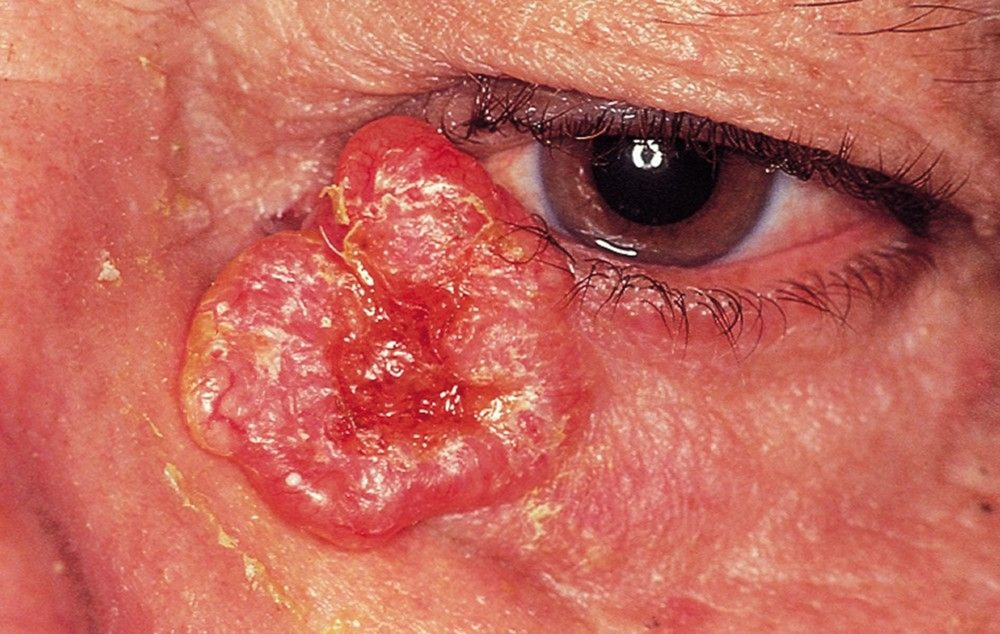 Nodular Basal Cell Carcinoma (2)