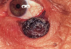 Carcinoma basocelular pigmentado