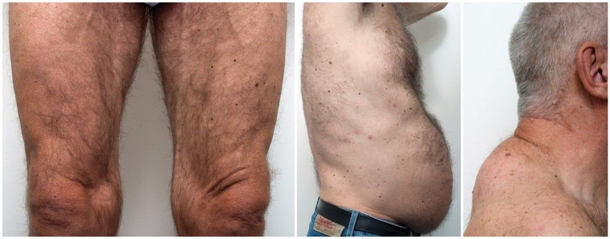 Lipodystrophy (Lipoatrophy) in HIV (2)