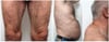 Lipodystrophie (lipoatrophie) dans le VIH (2)