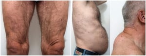 Lipodystrophie (lipoatrophie) dans le VIH (2)