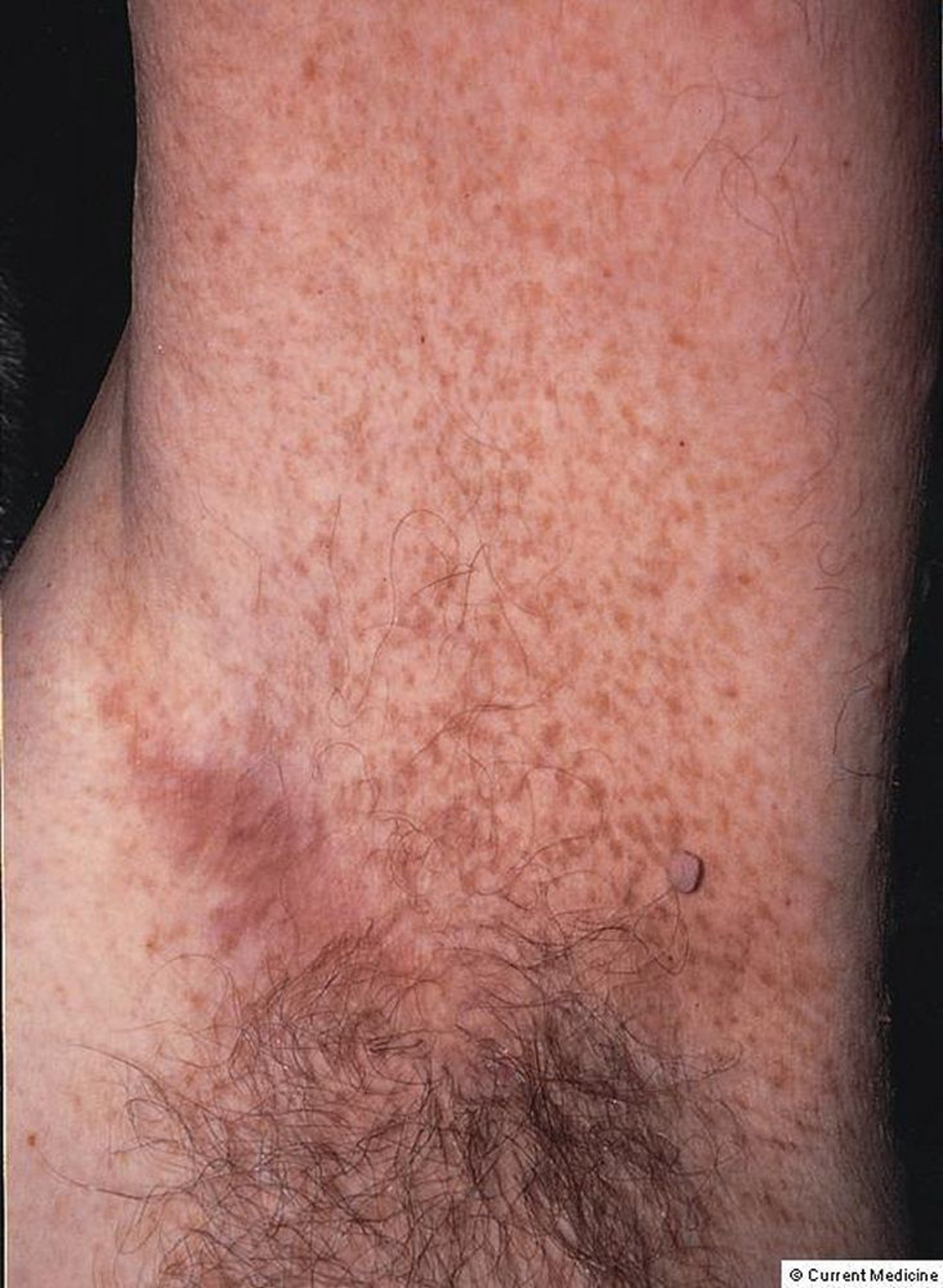 Skin Manifestations in Neurofibromatosis Type 1 (NF1)