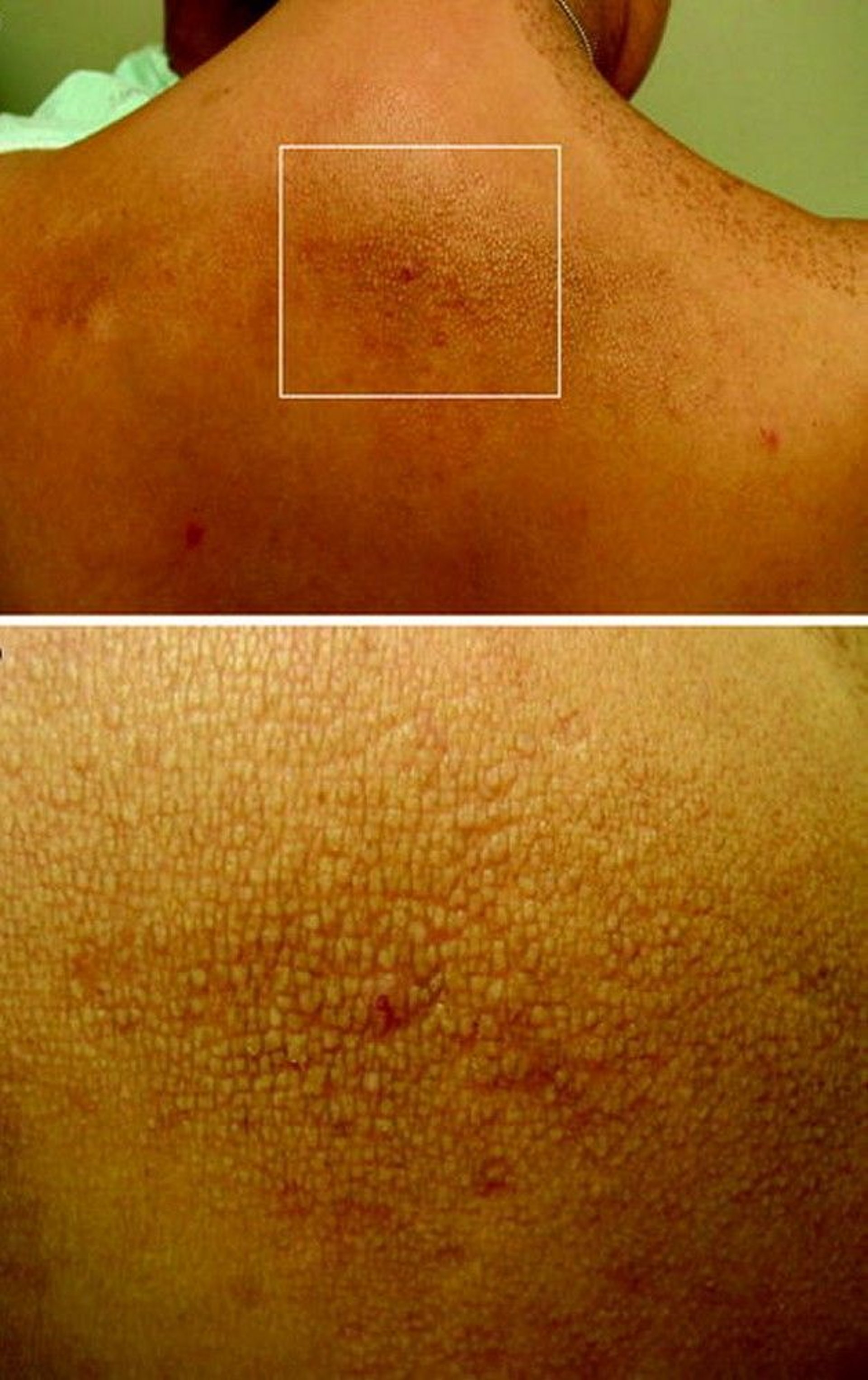 Cutaneous Lichen Amyloidosis