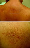 Amiloidosis cutánea por liquen
