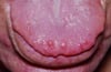 Neuroma mucoso