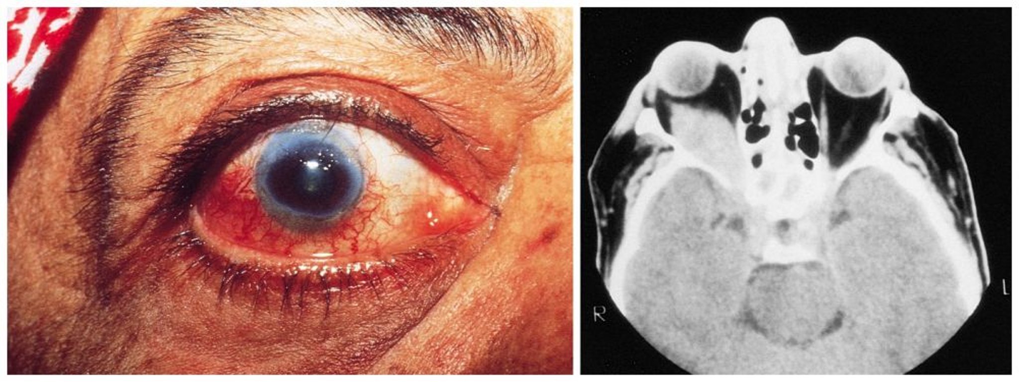 Granulomatosis con poliangeítis (hallazgos oculares)