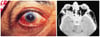 Granulomatose avec polyangéïte (signes oculaires)