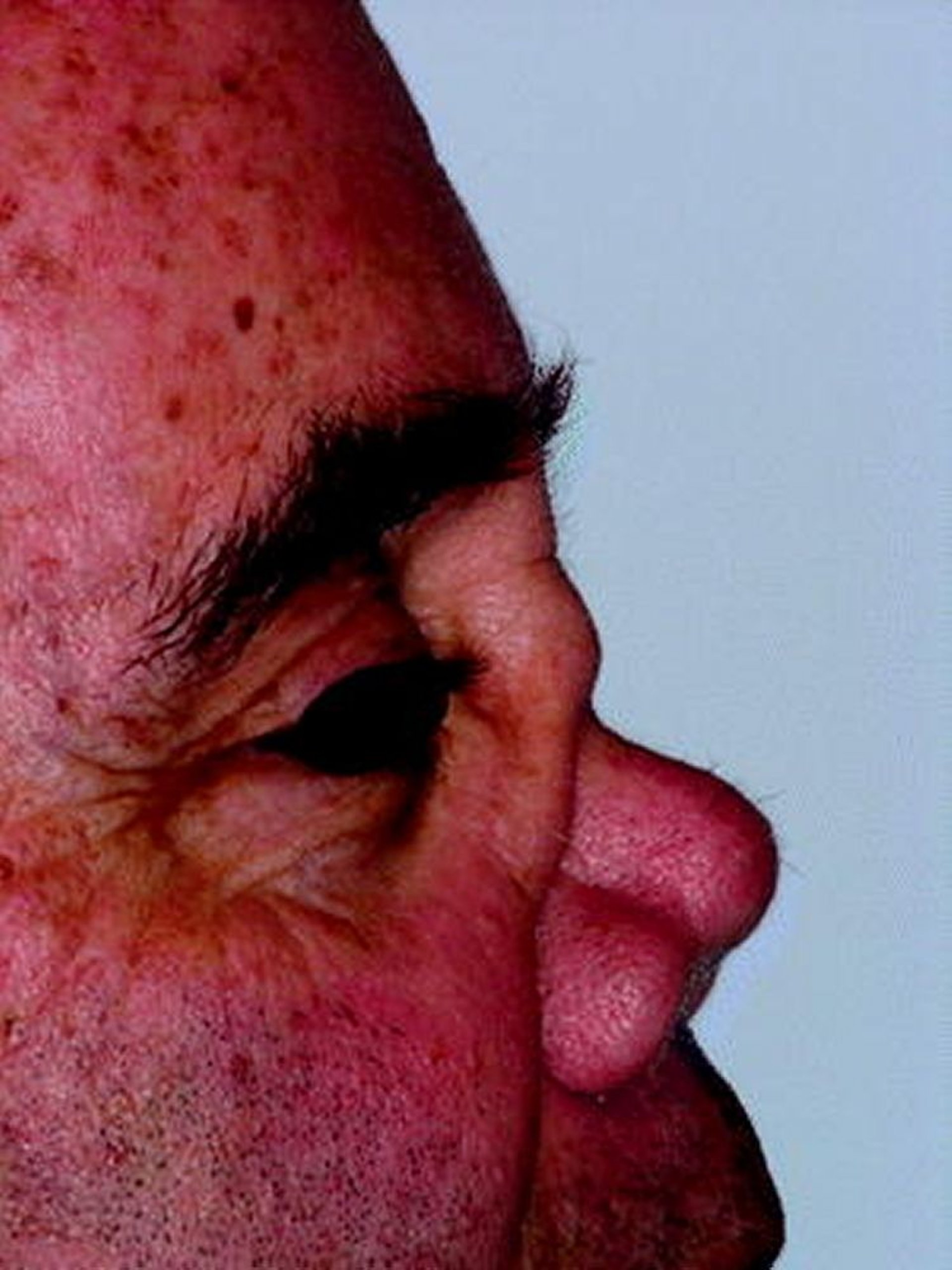 Déformation du nez en selle dans la granulomatose avec polyangéïte