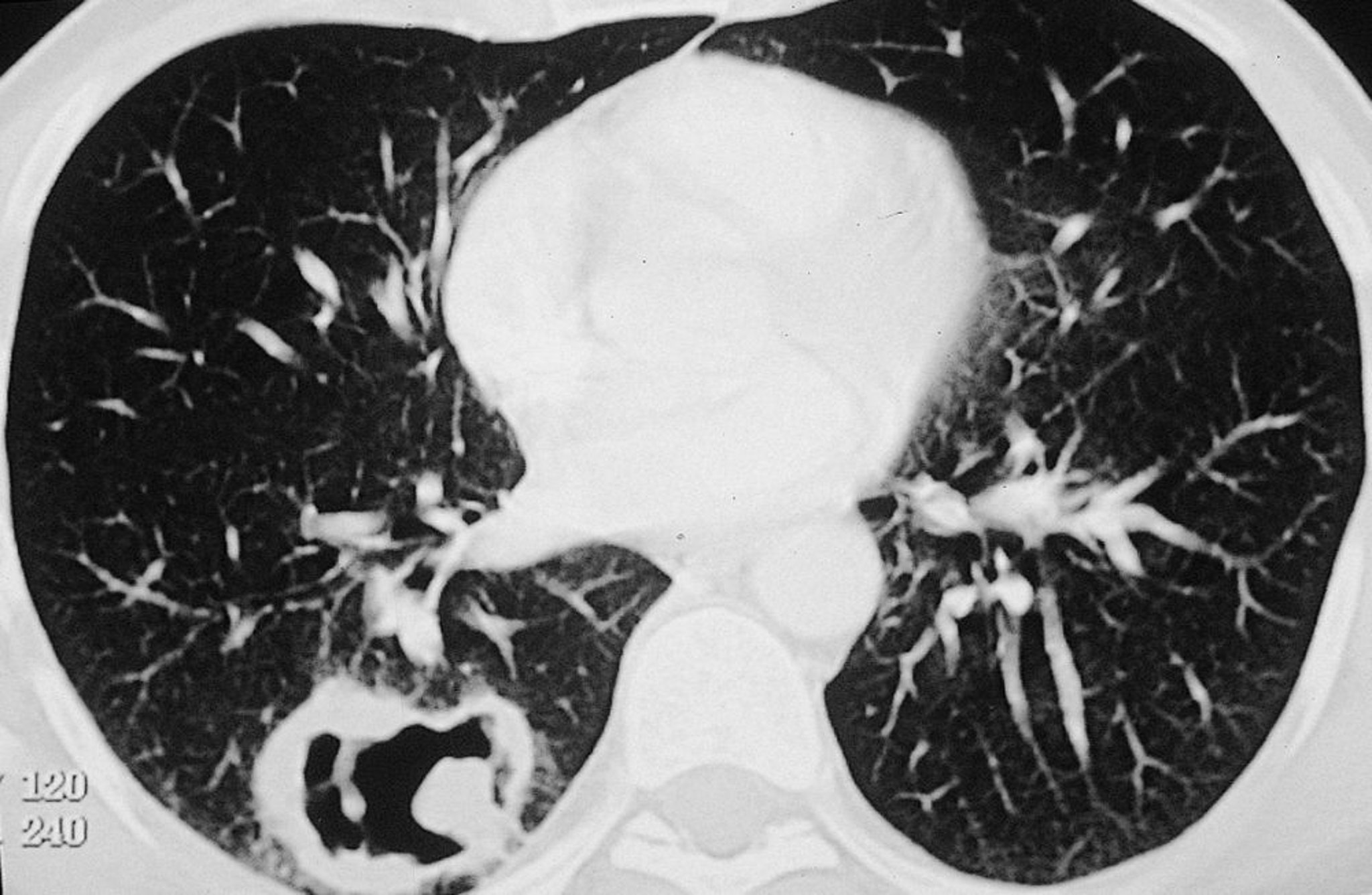 Granulomatosis con poliangeítis (lesión pulmonar)