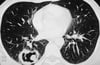 Granulomatose avec polyangéïte (lésion pulmonaire)