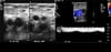 Doppler Ultrasound of a Patient with a Thrombus in Femoral Vein