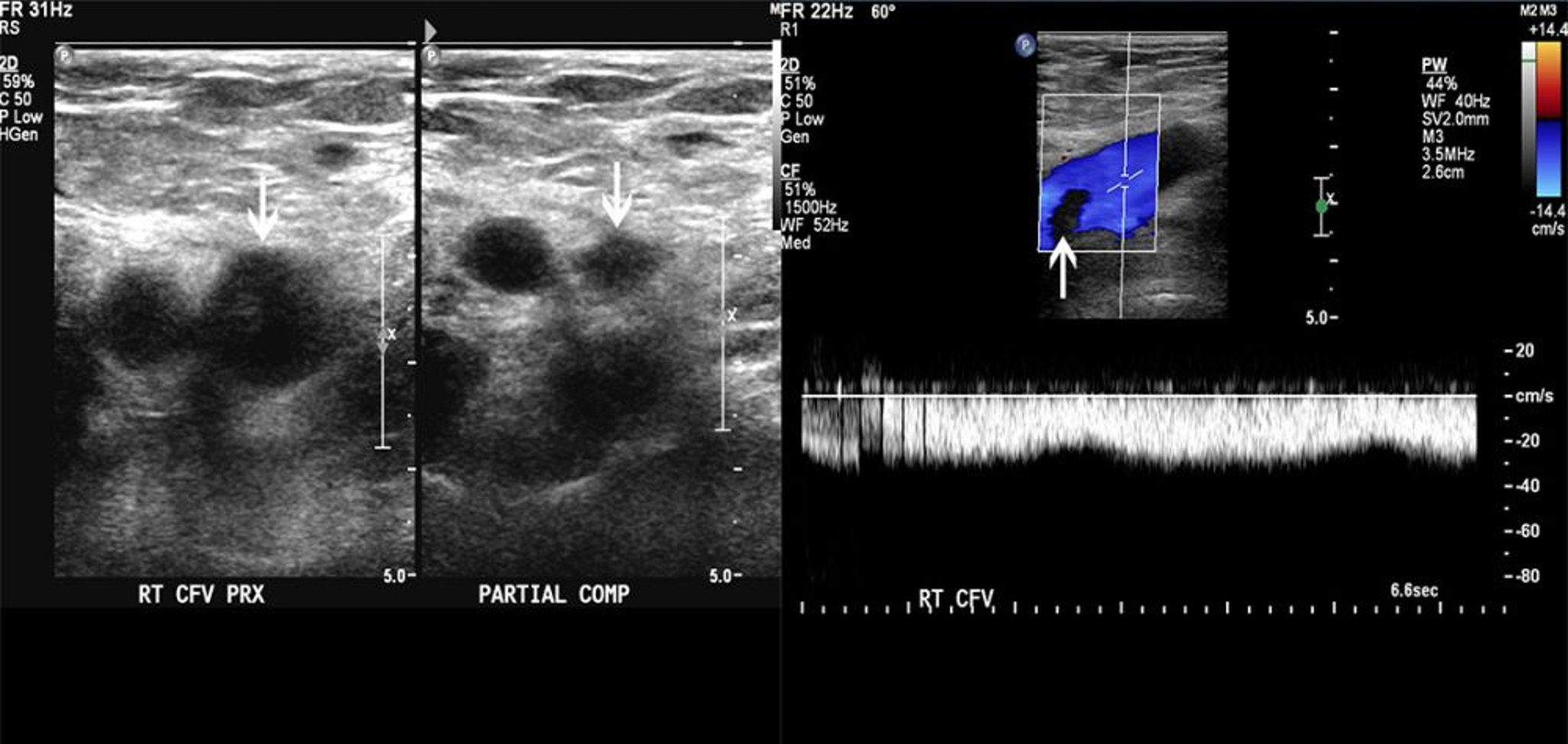 Doppler-Ultraschall eines Patienten mit einem Thrombus in der V. femoralis