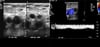 Ecografía Doppler de un paciente con un trombo en la vena femoral