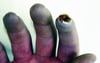 Síndrome de Raynaud com gangrena digital