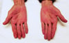 Cirrhosis (Palmar Erythema)