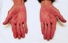 Cirrosis (eritema palmar)