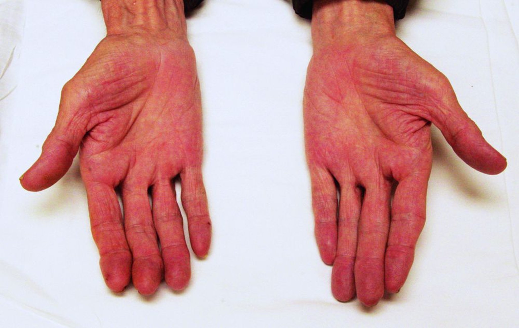 Cirrosis (eritema palmar)