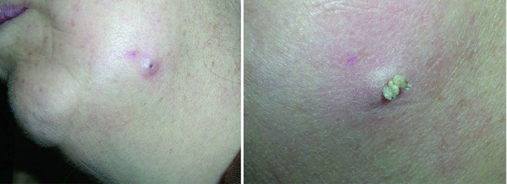 Cisti da inclusione epidermica