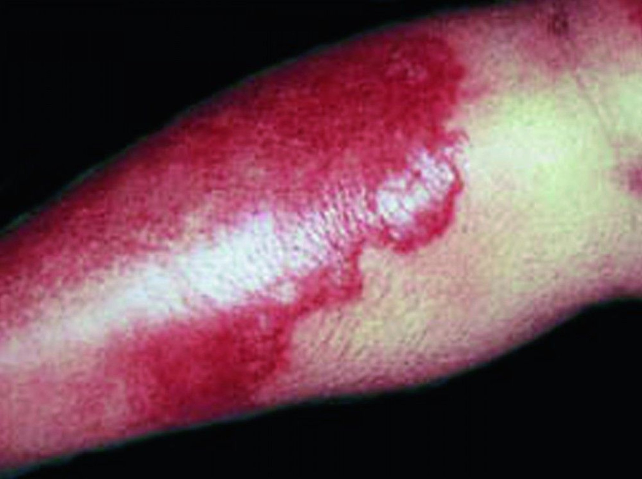 Erysipelas (Limb)