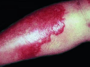 Erysipel (Extremität)