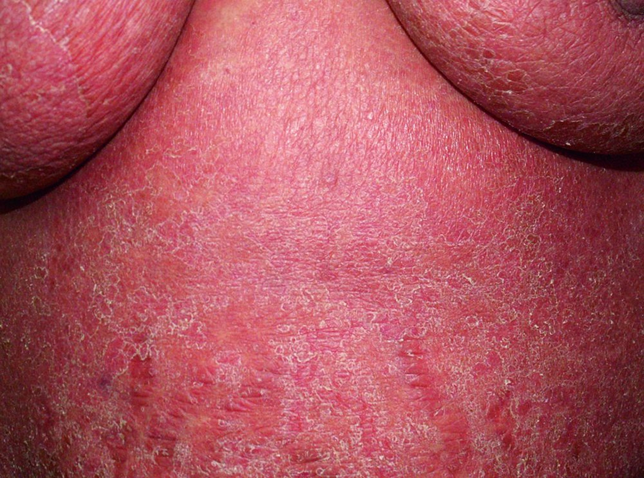 Érythrodermie