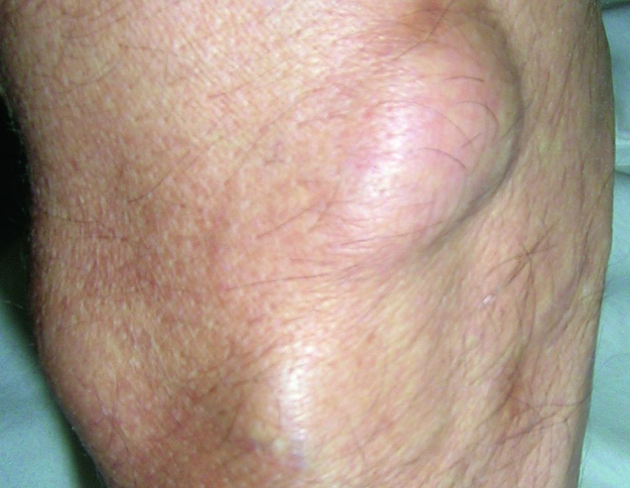 Lipoma