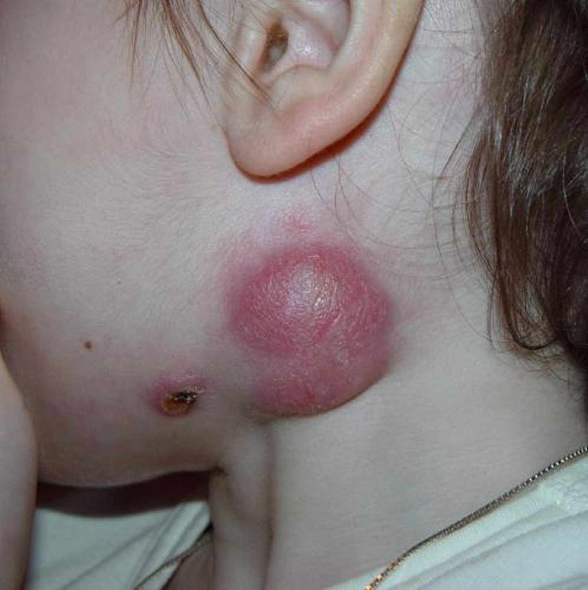 Linfadenitis (submandibular)