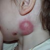 Linfadenite (submandibular)