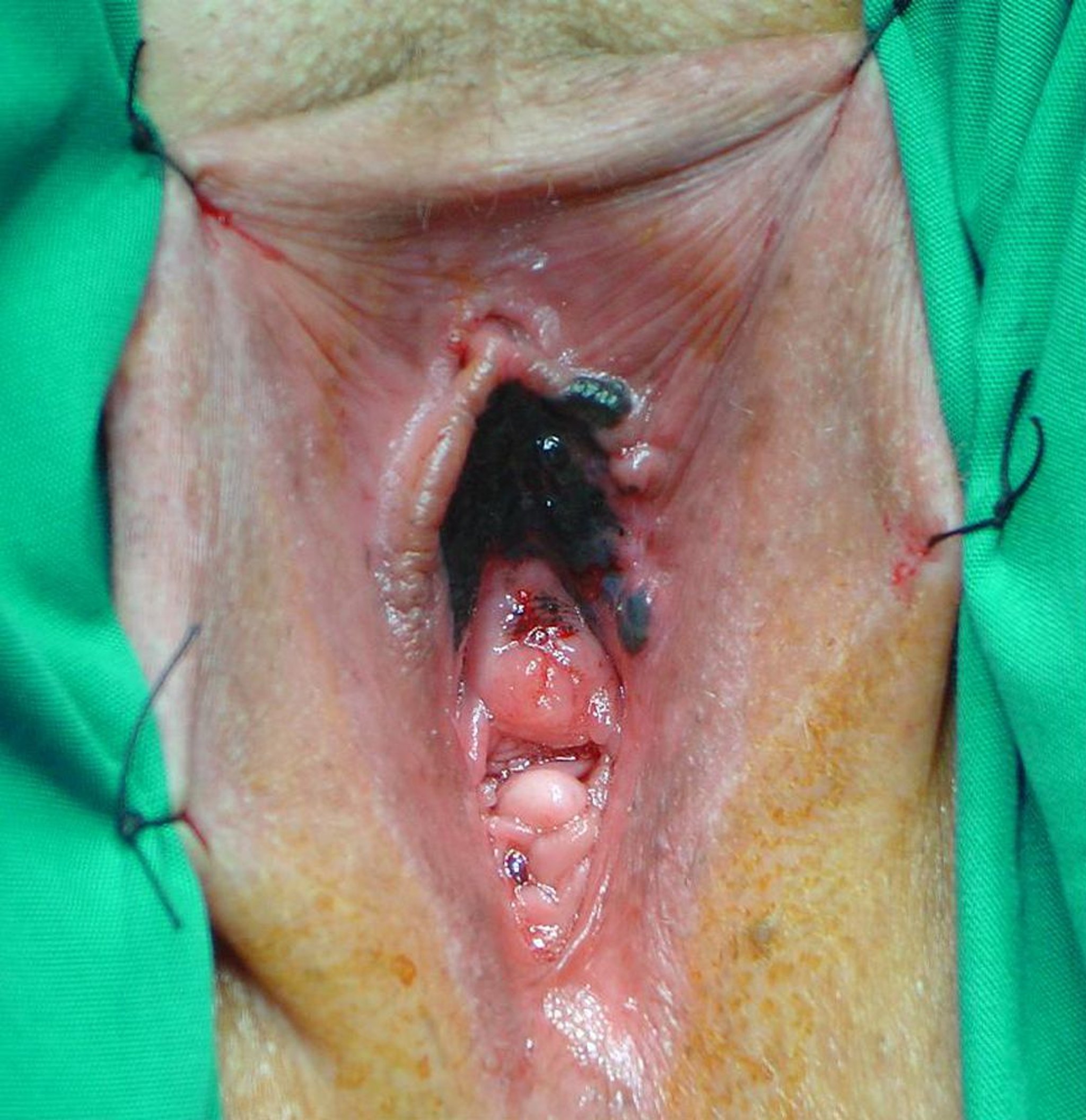 Melanoma vulvar maligno