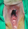Melanoma maligno vulvare
