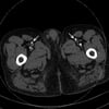 CT Scan of a Patient with Occlusion of Superficial Femoral Arteries