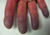 Raynaud Syndrome With Cyanosis
