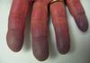 Syndrome de Raynaud avec cyanose