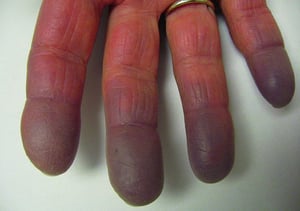 Syndrome de Raynaud avec cyanose
