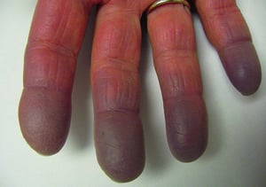 Hội chứng Raynaud với dấu hiệu xanh tím