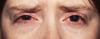 Rosacea oculare