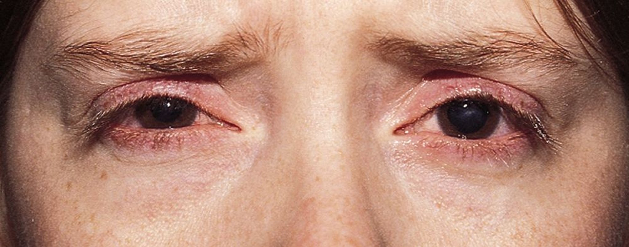 Rosacea oculare