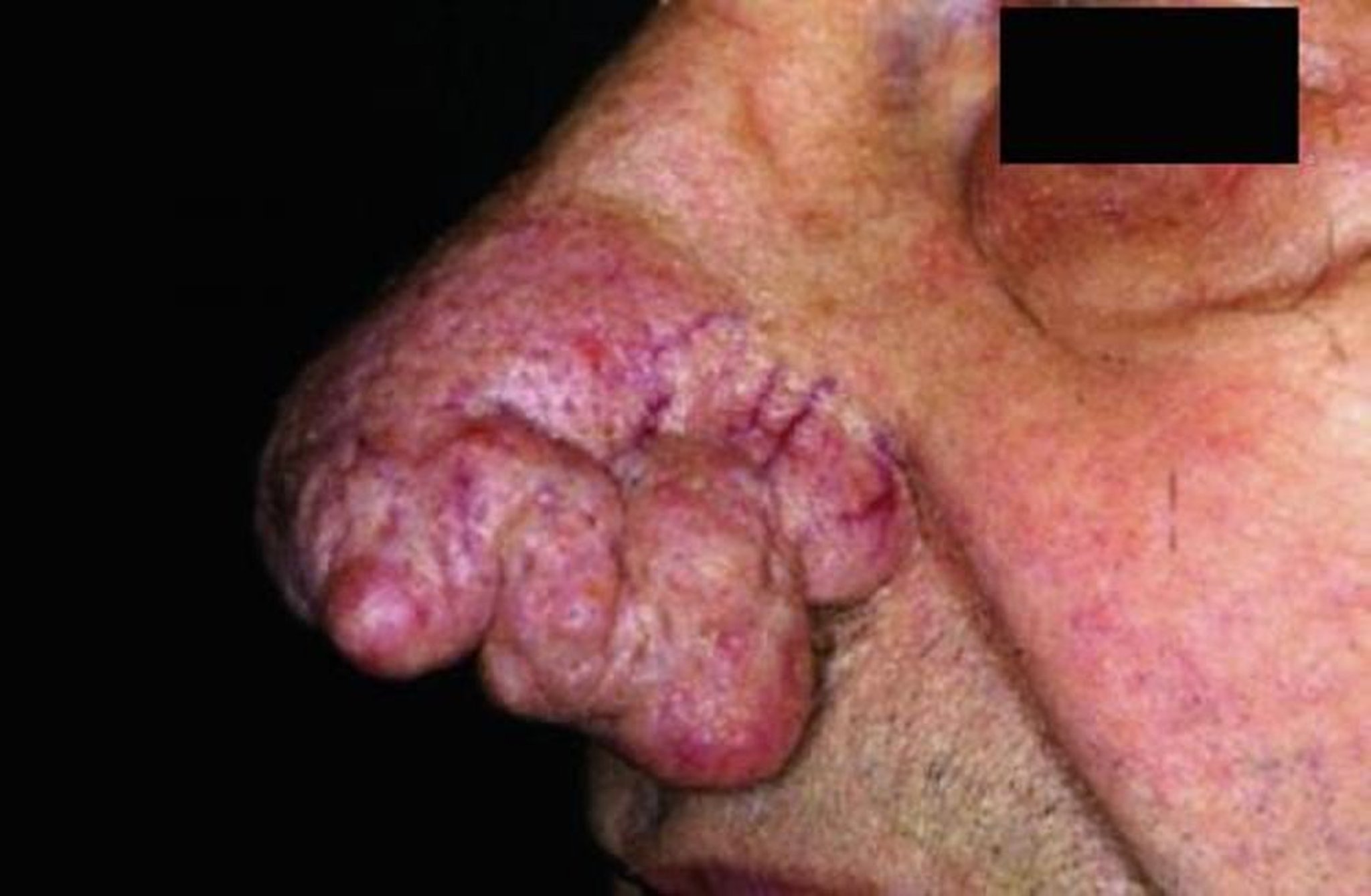 Rhinophyma de la rosacée