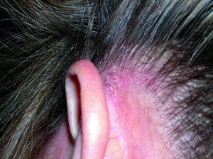 脂漏性皮膚炎（耳介後部）