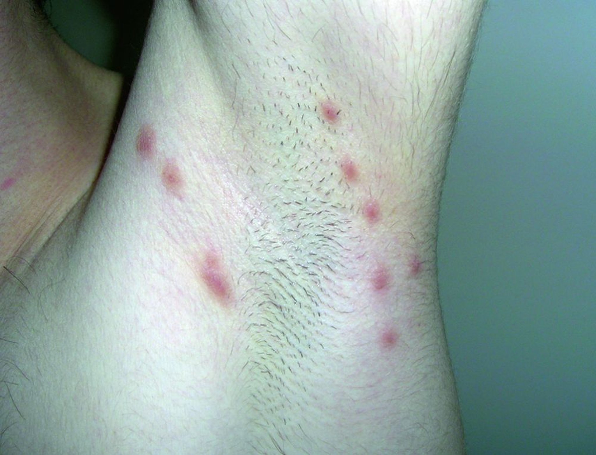 Nodular Scabies