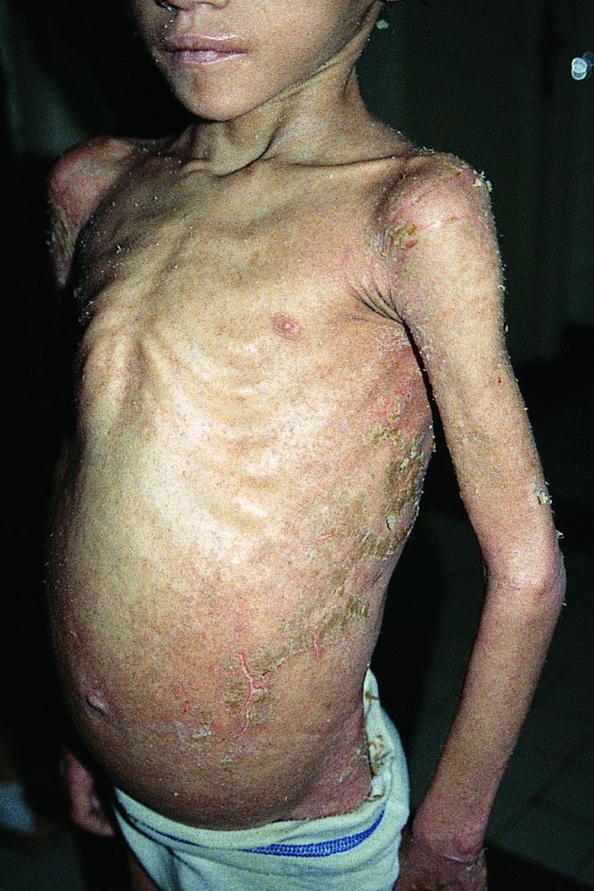 Crusted (Norwegian) Scabies