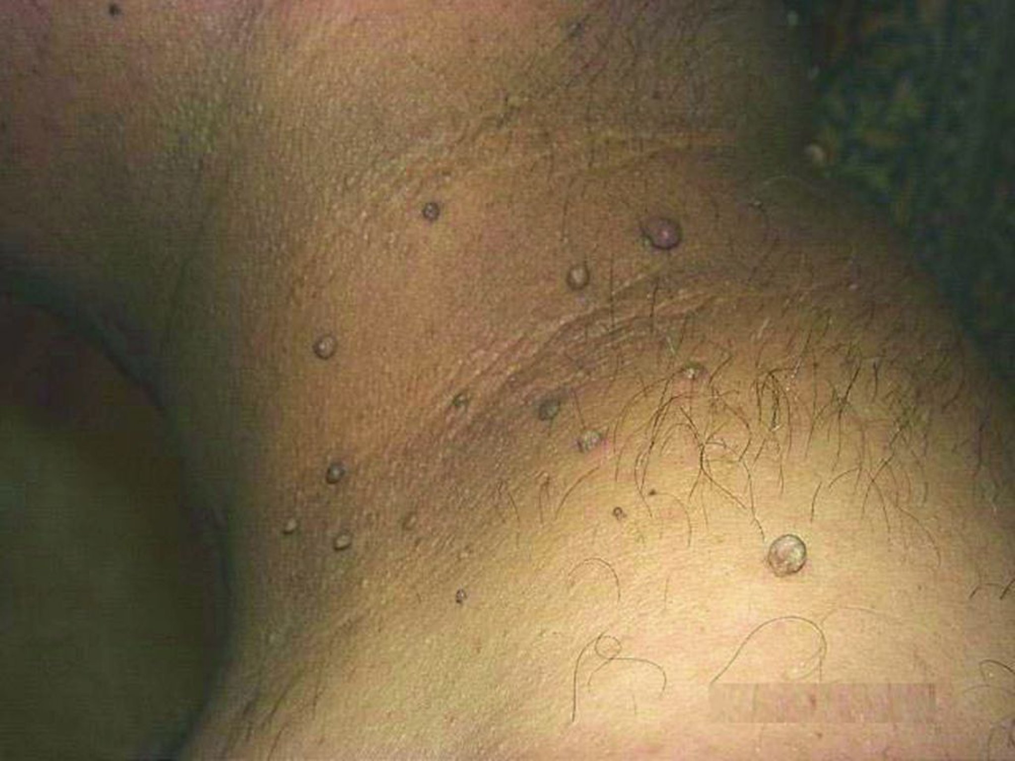 Weiche Fibrome