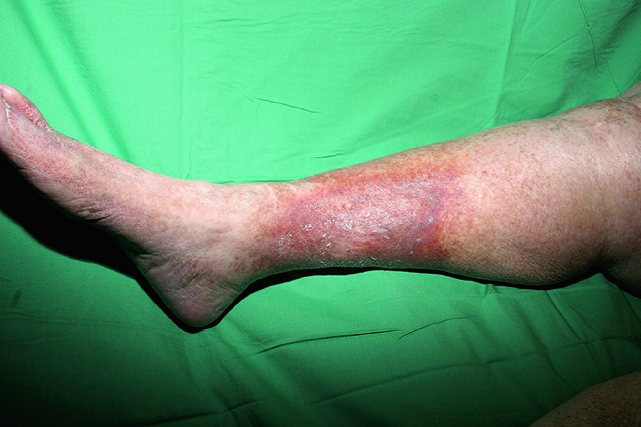 Sklerosierende Pannikulitis