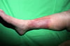 Paniculitis esclerosante